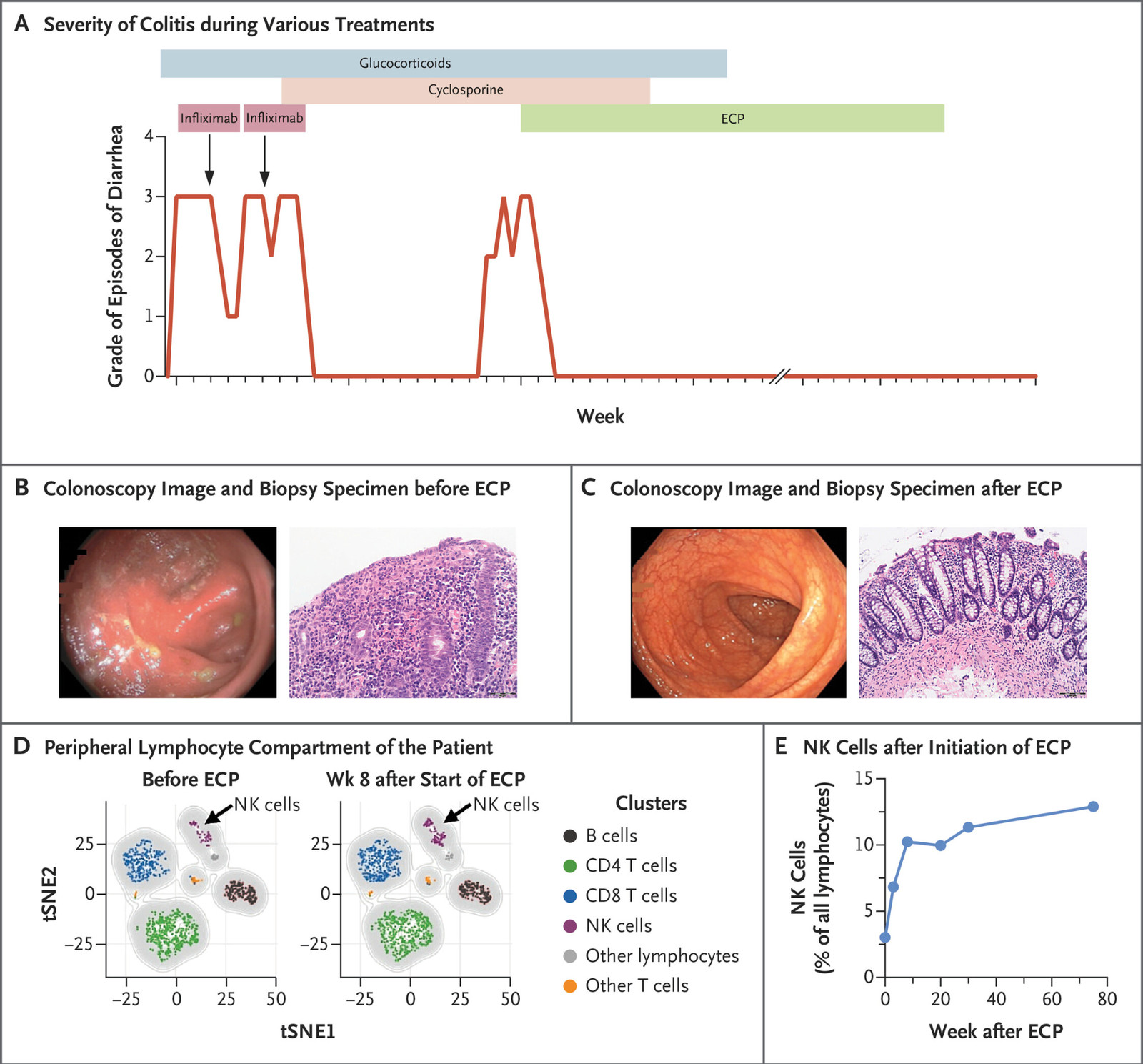 Extracorporeal Photopheresis for Colitis Induced by Checkpoint-Inhibitor Therapy